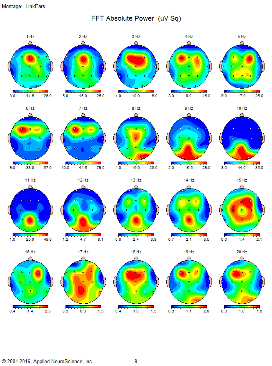 neurofeedback en madrid